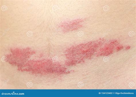 Midge Mosquito Bite Reaction To The Bite Of Midges Allergy Danger Of