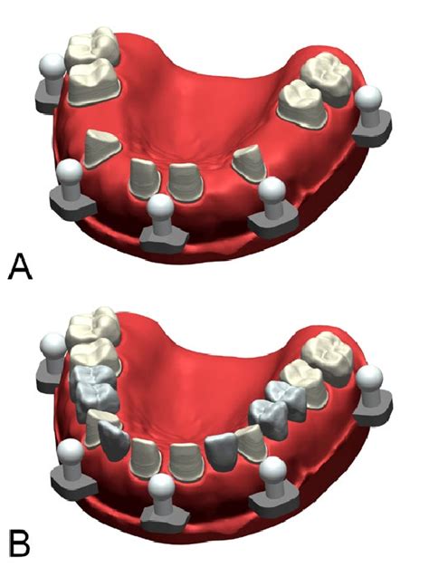 Three Dimensional Image Of Reference Models A Partially Edentulous