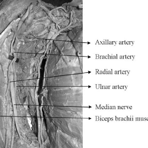 Posterior Circumflex Humeral Artery Giving Origin To Radial And Middle