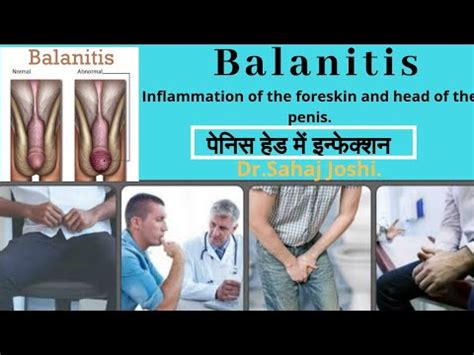 Balanitis पनस हड म इनफकशन And Its Treatment YouTube