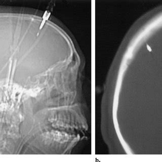 Programmable Shunt A Lateral Radiograph Of The Skull Shows A