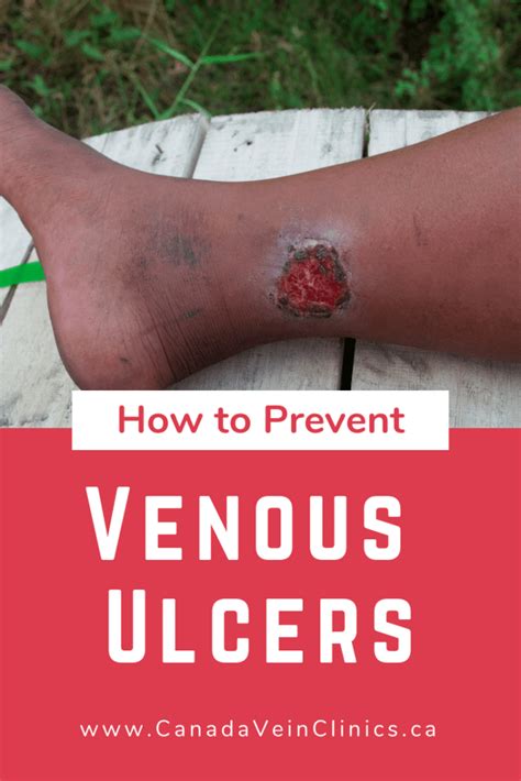 Venous Ulcers Complications Of Varicose Veins Canada Vein Clinics