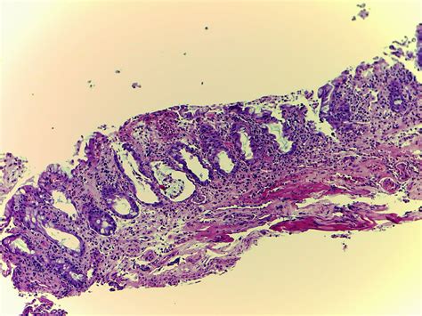 gastrointestinal and liver histology pathology atlas colon ischemic colitis