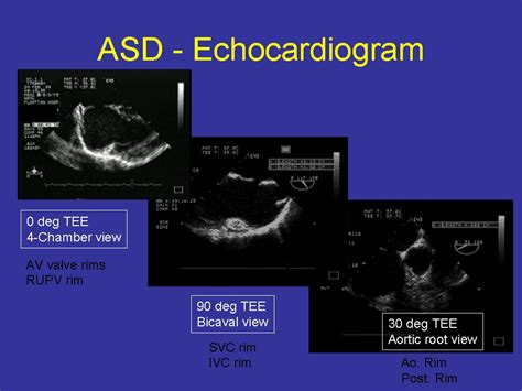 Pedi Cardiology Echo Asd Tee Evaluation Of Rims For Transcatheter