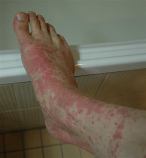 Heat Rash On Top Of Feet Foot Rash Causes Symptoms Home Remedies