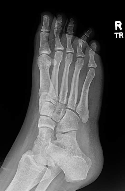 Proximal Phalanx Fracture Of The Foot Xray Prereduction Unannotated