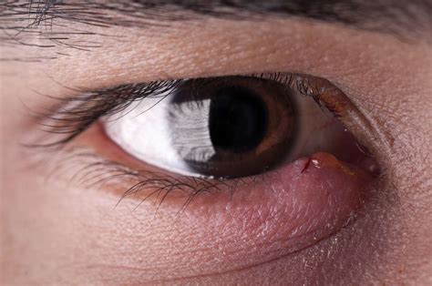 Bump On The Eyelid Types Symptoms Causes Treatment
