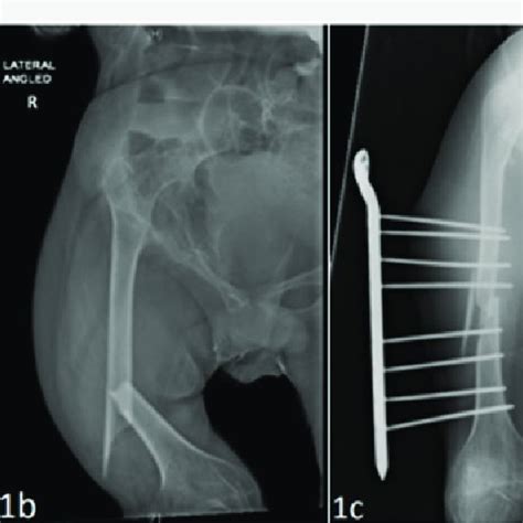 1a Preoperative 1b Antero Posterior And Lateral Angled Radiographs