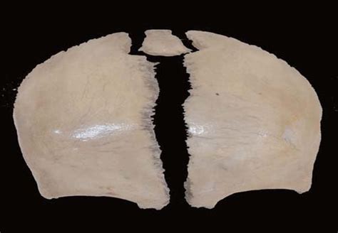 Interparietal Sutural Bone With Kind Permission Of The Museum Villa