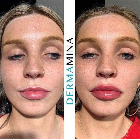 Non Surgical Lip Enhancement · Dermamina
