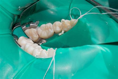 Composite Resins Durable Natural Looking Fillings For Your Teeth