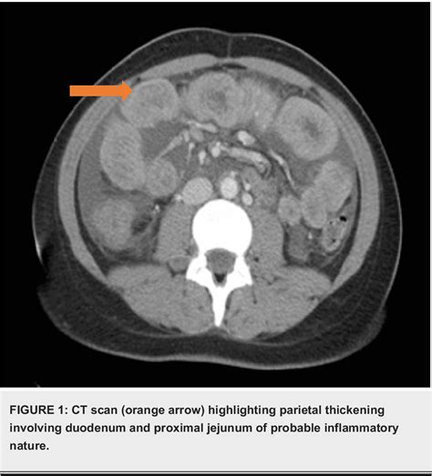 Figure 1 From Eosinophilic Ascites An Infrequent Presentation Of