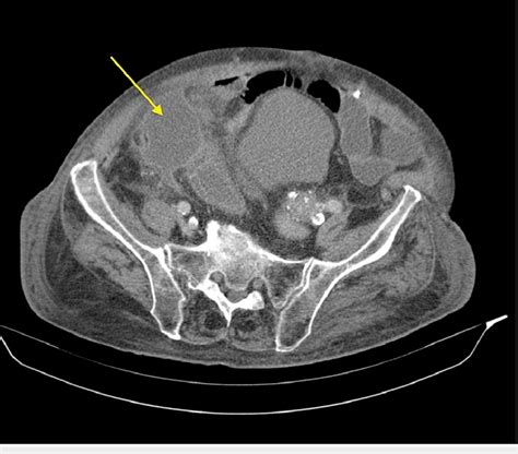 Ct Scan Showing Perforated Gallbladder Arrow Ct Computed Tomography
