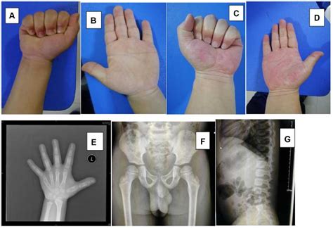 Figure 2 From A Review Of Three Chinese Cases Of Acromicricgeleophysic