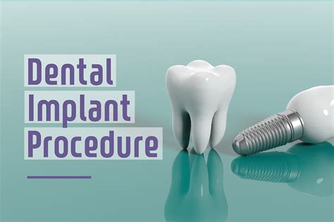 Step By Step Two Stage Dental Implant Procedure In Burbank Air Dental