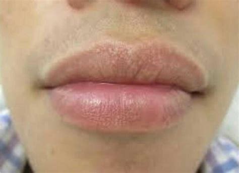 Itchy Lips Symptoms Causes Treatment And Prevention
