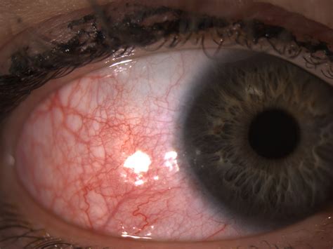Sore Red Eye Cornea And Conjunctiva Advanced Eye Surgery Scotland Forum