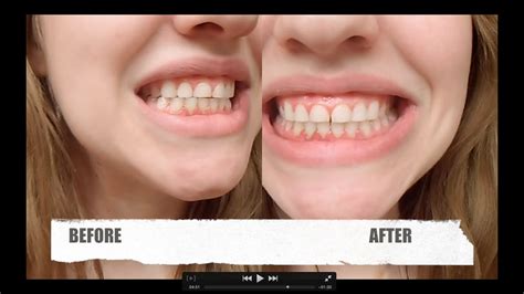 Dr Song Teeth Whitening Review Before And After Use Youtube