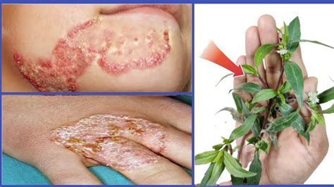 How To 2 Days Fungal Infection Treatment At Home Youtube