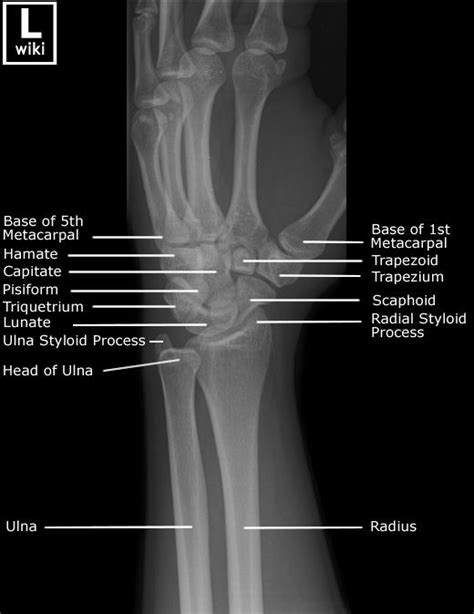 Scaphoid Bone Anatomy Lateral Radiograph