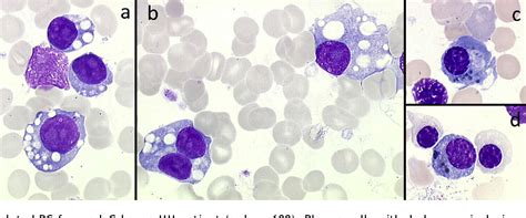 Figure 15 From Plasma Cell Morphology In Multiple Myeloma And Related