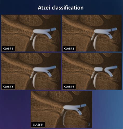 Atzei Classification Of Peripheral TFCC Tears Radiology Reference Article Radiopaedia Org