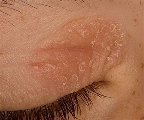 Eczema On Eyelid Symptoms Causes Pictures Treatment Images And Photos