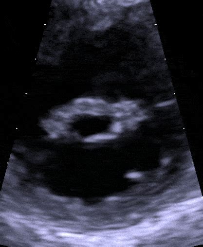 Mitral Stenosis A Tight Mitral Valve • Myheart