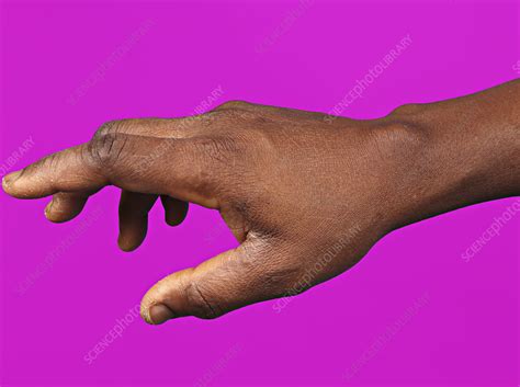 Synovial Cyst Of The Wrist Stock Image C050 7425 Science Photo