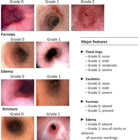 Pdf The Role Of Endoscopy In Eosinophilic Esophagitis From Diagnosis