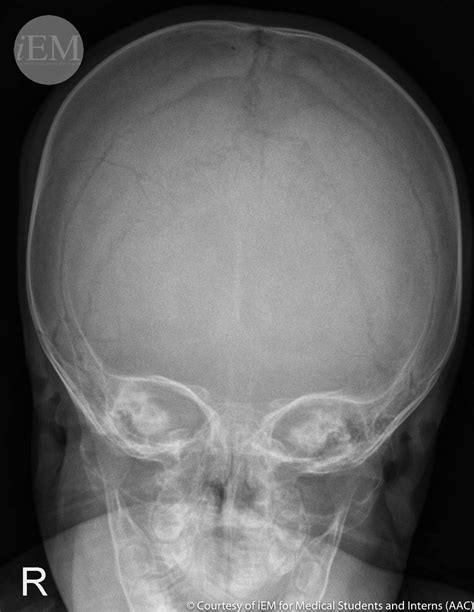 4402 Skull Fx Occipital2 Occipital Skull Fracture Flickr