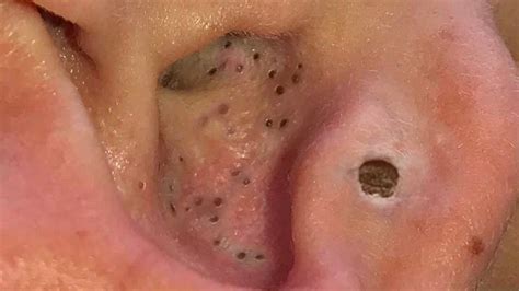 According to the preview for this episode of dr. Ear Blackheads 2019 - Best Summer Blackhead Pops - Pimple ...