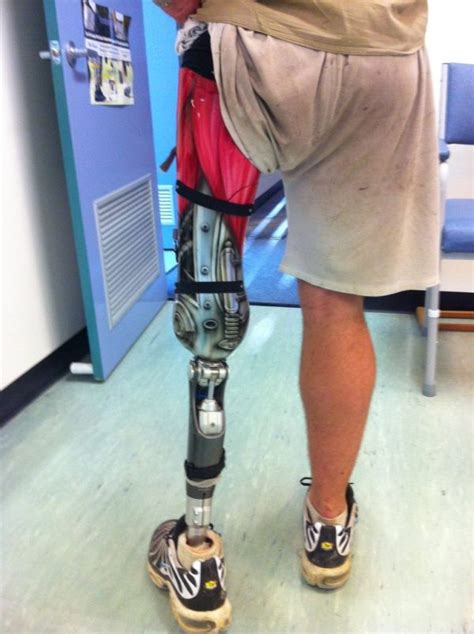 Awesome Prosthetic Leg 7 Pics