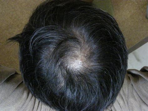 はげない、めげない、まけない:ミノキシジル - livedoor Blog ...