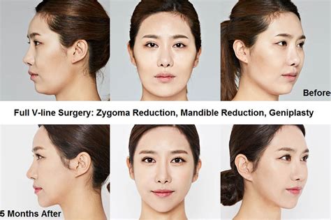 53 Most Popular Plastic Surgery Procedures In Korea Seoul Guide Medical