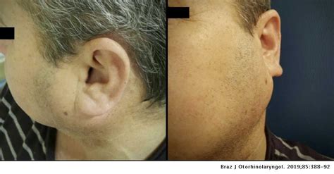 Synchronous Multiple Unilateral Parotid Gland Tumors Of Benign And