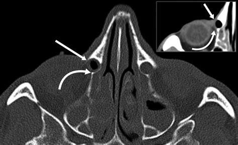 A Comprehensive Review Of Cross Sectional Imaging Of The Nasolacrimal