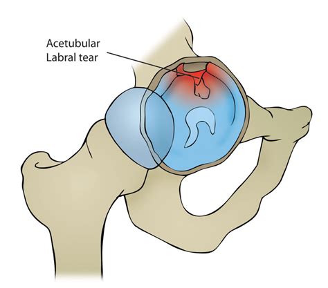 Hip Labral Tear Motus Physical Therapy