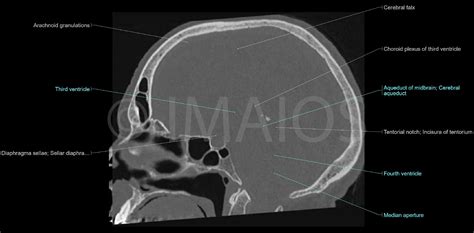 Bones Of Cranium Anatomy Ct Sphenoid Bone Occipital Bone Clivus