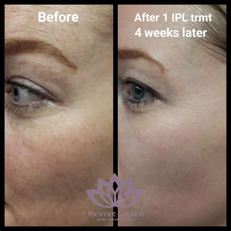 Ipl Before And After 2mb Revive Laser And Skin Clinic