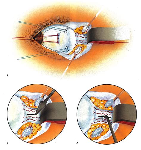 Optic Nerve Sheath Decompression American Academy Of Ophthalmology