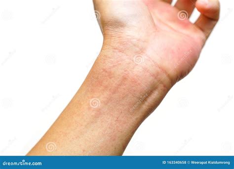 Red Rash On Wrist Stock Photo Image Of Copy Medical 163340658