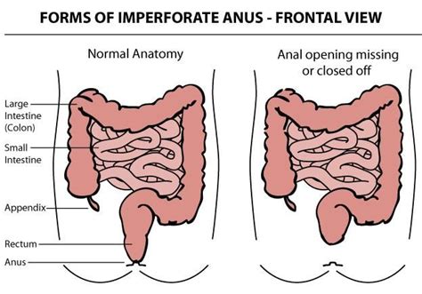 When A Malformation Of The Anus Is Present The Muscles And Nerves Associated With The Anus