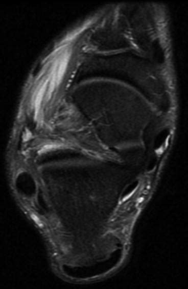 Mri of the soft tissues of the foot visualizes the fat cushions of the sole, heels, fingers and can show swelling, foci of infiltration and inflammation. Radiological Imaging of Foot Injuries | Radiology Key