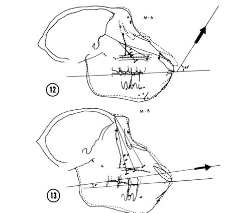 Proof Moving The Maxilla Is Possible In Adults Face Pulling