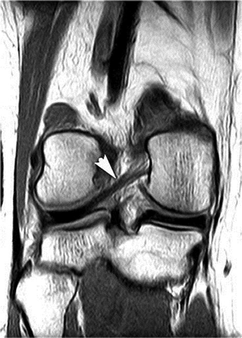 Normally, the acl is a dark structure in the center of the knee. A Twenty-nine-Year-Old Woman with a Twisting Injury to the Right Knee - JBJS Image Quiz