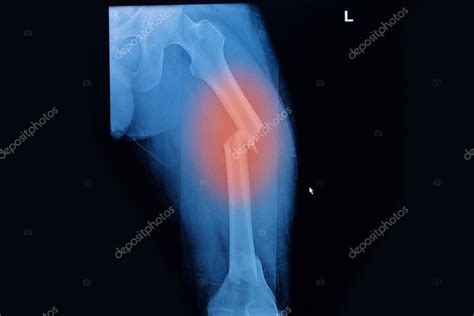 Fractured Femur Broken Leg X Rays Image — Stock Photo © Plepraisaeng