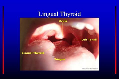 Ppt Development Of Tongue Thyroid Gland Face And Palate Powerpoint