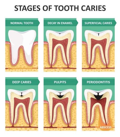 Premium Vector Stages Of Tooth Caries Tooth Caries Dental