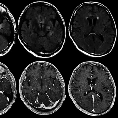 Brain Mri Findings Taken One Week After Hospital Admission Download